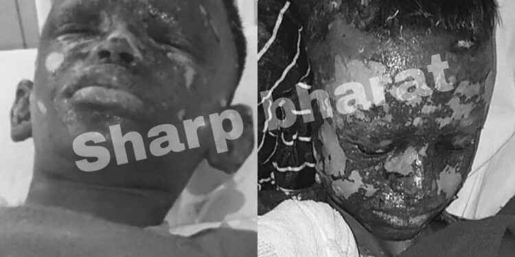 jamshedpur crackers burst – सीतारामडेरा में पटाखा छोड़ने में दो बच्चे घायल, अचानक से फट गया पटाखे jamshedpur crackers burst – सीतारामडेरा में पटाखा छोड़ने में दो बच्चे घायल, अचानक से फट गया पटाखे