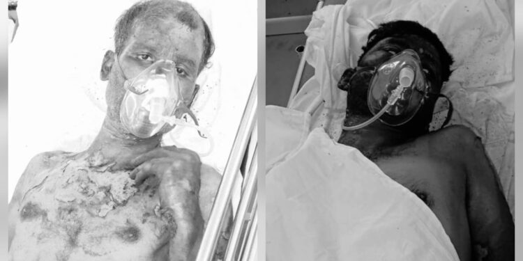 saraikela chandil blast- चांडिल स्थित गैलेक्सी इंगोट प्लांट में ब्लास्ट, दो मजदूर झुलसे, टीएमएच में भर्ती