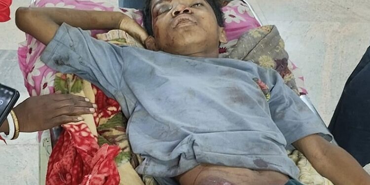Jamshedpur rural teenager injured : बोड़ाम के हलुदबनी में आम तोड़ते पेड़ से गिर कर किशोर जख्मी, गंभीर अवस्था में एमजीएम अस्पताल में कराया गया भर्ती, साकची पीपुल्स एकेडमी का छात्र है जख्मी फुदान बास्के Jamshedpur rural teenager injured : बोड़ाम के हलुदबनी में आम तोड़ते पेड़ से गिर कर किशोर जख्मी, गंभीर अवस्था में एमजीएम अस्पताल में कराया गया भर्ती, साकची पीपुल्स एकेडमी का छात्र है जख्मी फुदान बास्के