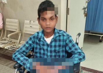 Jamshedpur mgm hospital doctors : एमजीएम अस्पताल के डॉक्टरों ने बचाई हाई वोल्ट करंट से झुलसे 13 वर्षीय किशोर की जान, कृत्रिम पैरों के सहारे फिर चलने लगा रातू Jamshedpur mgm hospital doctors : एमजीएम अस्पताल के डॉक्टरों ने बचाई हाई वोल्ट करंट से झुलसे 13 वर्षीय किशोर की जान, कृत्रिम पैरों के सहारे फिर चलने लगा रातू