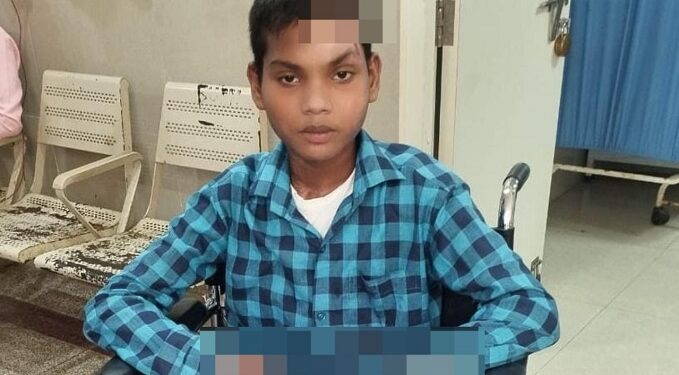 Jamshedpur mgm hospital doctors : एमजीएम अस्पताल के डॉक्टरों ने बचाई हाई वोल्ट करंट से झुलसे 13 वर्षीय किशोर की जान, कृत्रिम पैरों के सहारे फिर चलने लगा रातू Jamshedpur mgm hospital doctors : एमजीएम अस्पताल के डॉक्टरों ने बचाई हाई वोल्ट करंट से झुलसे 13 वर्षीय किशोर की जान, कृत्रिम पैरों के सहारे फिर चलने लगा रातू